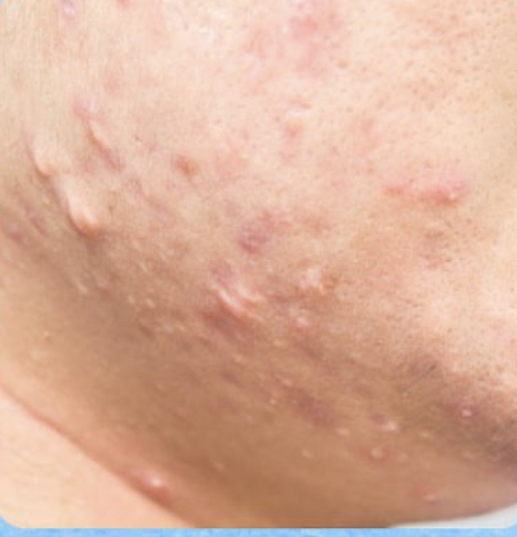 Cicatrices Hipertróficas